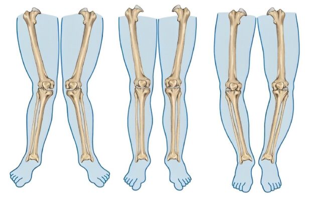 Giải đáp chi tiết: Cách phòng tránh bệnh còi xương ở trẻ là gì?