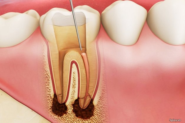 GIẢI ĐÁP: Có cần phải lấy tủy khi bọc răng sứ không?