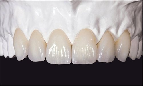 Giải đáp: Có nên bọc răng sứ zirconia và những điều cần biết