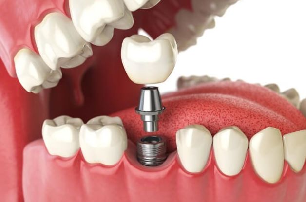 Giải đáp có nên trồng răng Implant giá rẻ nhất không