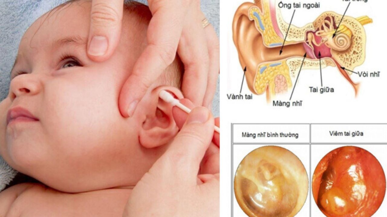 Giải đáp có nên tự điều trị bệnh viêm tai giữa cho trẻ không