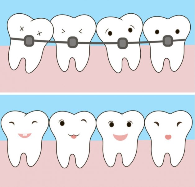 Giải đáp: Cười hở lợi phải làm sao để khắc phục?