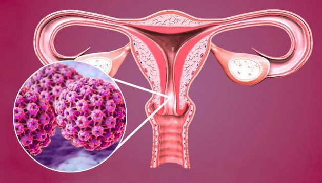 Giải đáp: Đã bị HPV có nên tiêm vacxin và thời điểm nên tiêm