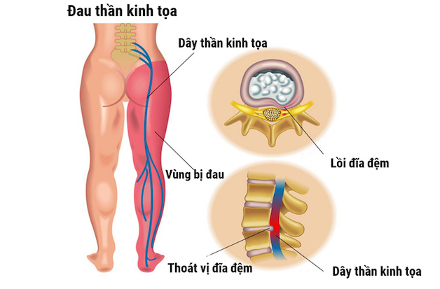 Giải đáp: Đau thần kinh tọa có chữa khỏi không?