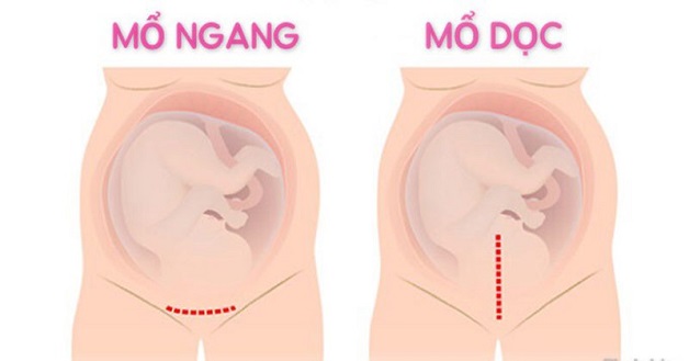 Giải đáp: Đẻ mổ dọc hay ngang? Cách chăm sóc vết mổ sau sinh