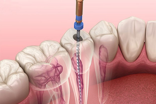 GIẢI ĐÁP: Điều trị tủy răng có đau không? 