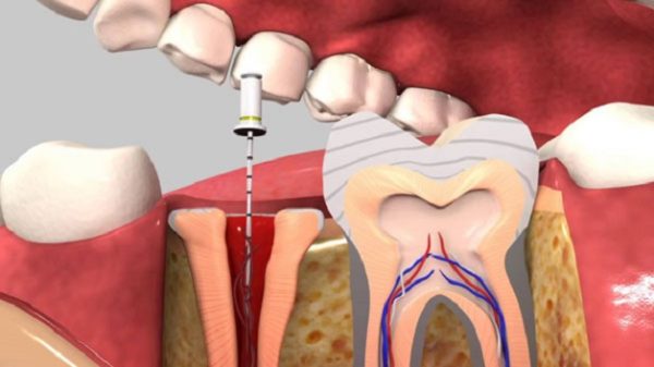 GIẢI ĐÁP: Điều trị tủy răng có đau không? 