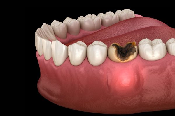 Giải đáp: Điều trị tủy răng có nên bọc sứ không?