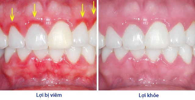 Giải đáp: Khi bị viêm lợi phải làm sao?