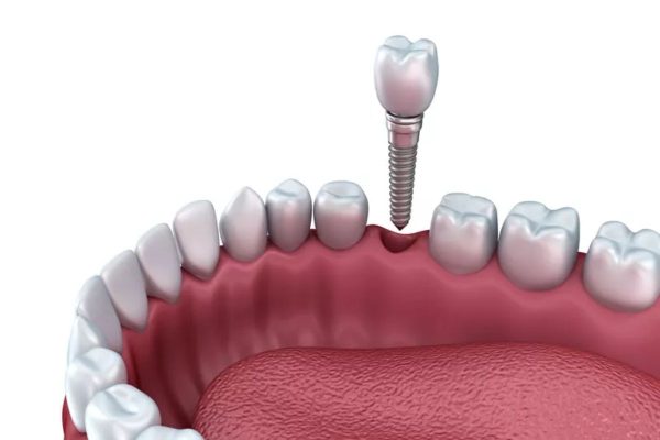 Giải đáp: Khi nào cần cấy implant cho răng?