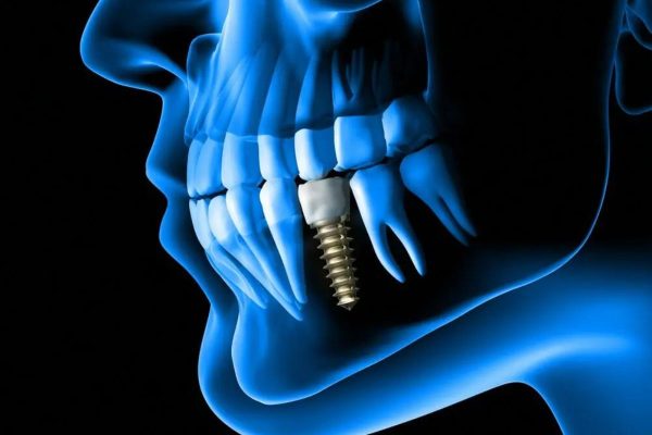 Giải đáp: Khi nào cần cấy implant cho răng?