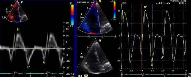 Giải đáp: Khi nào cần siêu âm doppler tim?