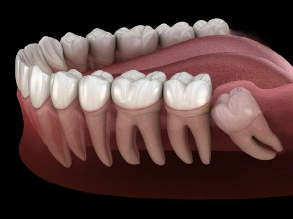 GIẢI ĐÁP: Khi nào nên nhổ răng khôn?