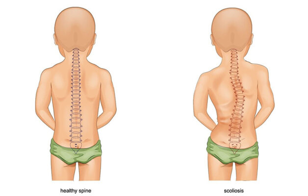 Giải đáp: Làm thế nào để chữa bệnh còi xương?