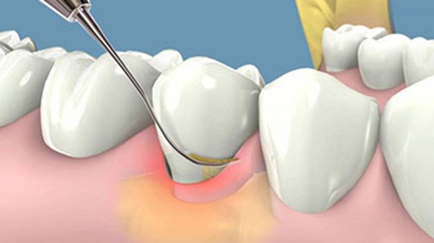 GIẢI ĐÁP: Lấy cao răng có hết hôi miệng không?