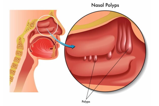 Giải đáp: Mổ polyp mũi ở đâu tại Hà Nội thì tốt?