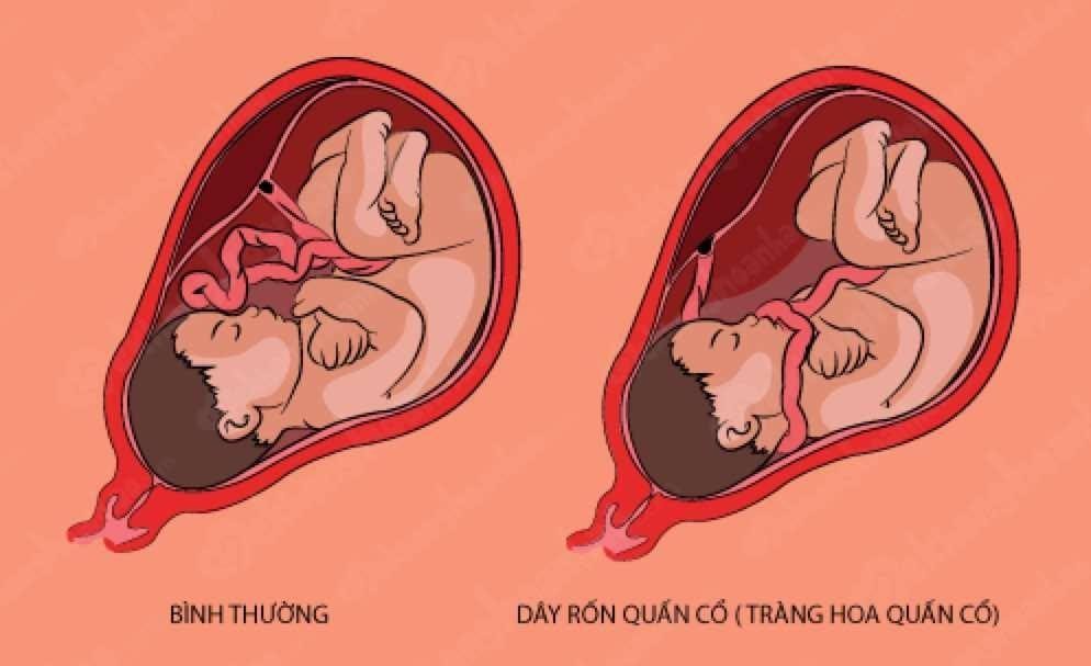 Giải đáp mọi thắc mắc liên quan đến dây rốn quấn cổ