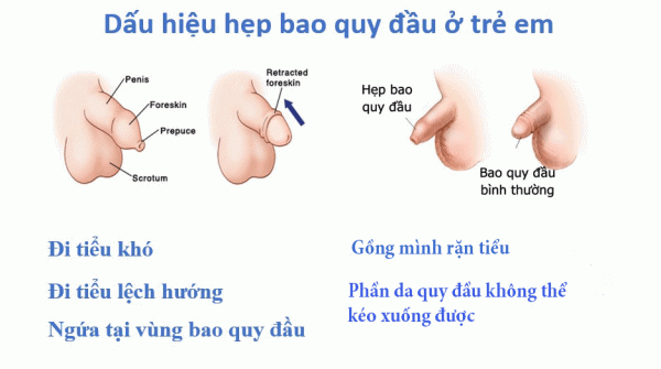 Giải đáp mọi thắc mắc về hẹp bao quy đầu ở trẻ nhỏ