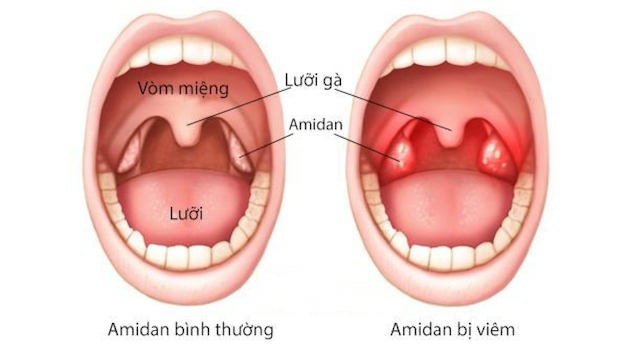 Giải đáp mọi thắc mắc về “trẻ viêm amidan”