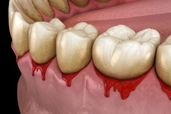 Giải đáp nha khoa: Có nên lấy cao răng không?