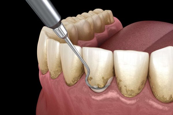 Giải đáp nha khoa: Có nên lấy cao răng không?