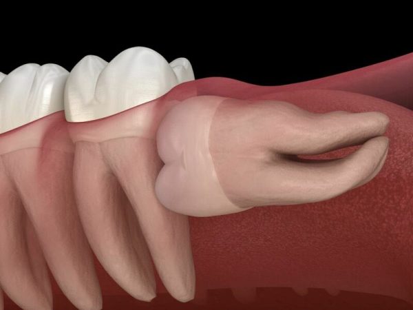 GIẢI ĐÁP: Nhổ răng mọc ngầm có nguy hiểm không?