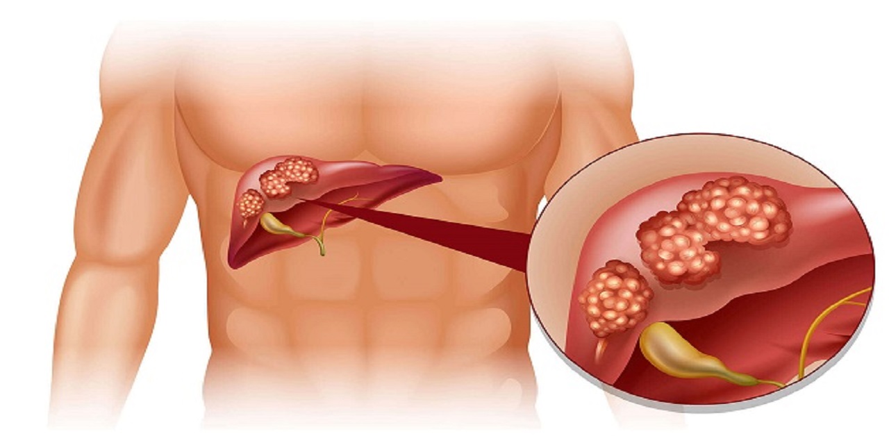 Giải đáp nỗi lo: Bệnh ung thư gan có lây không?