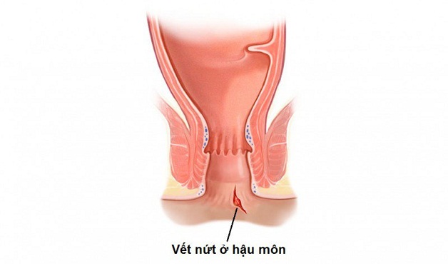 Nứt kẽ hậu môn ở phụ nữ sau sinh là nỗi "ám ảnh" của nhiều sản phụ