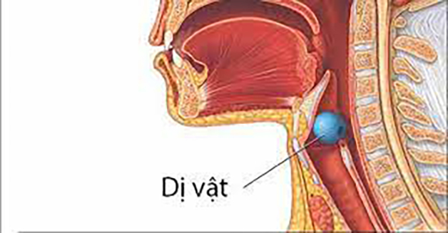 Giải đáp: Quy trình lấy dị vật họng miệng