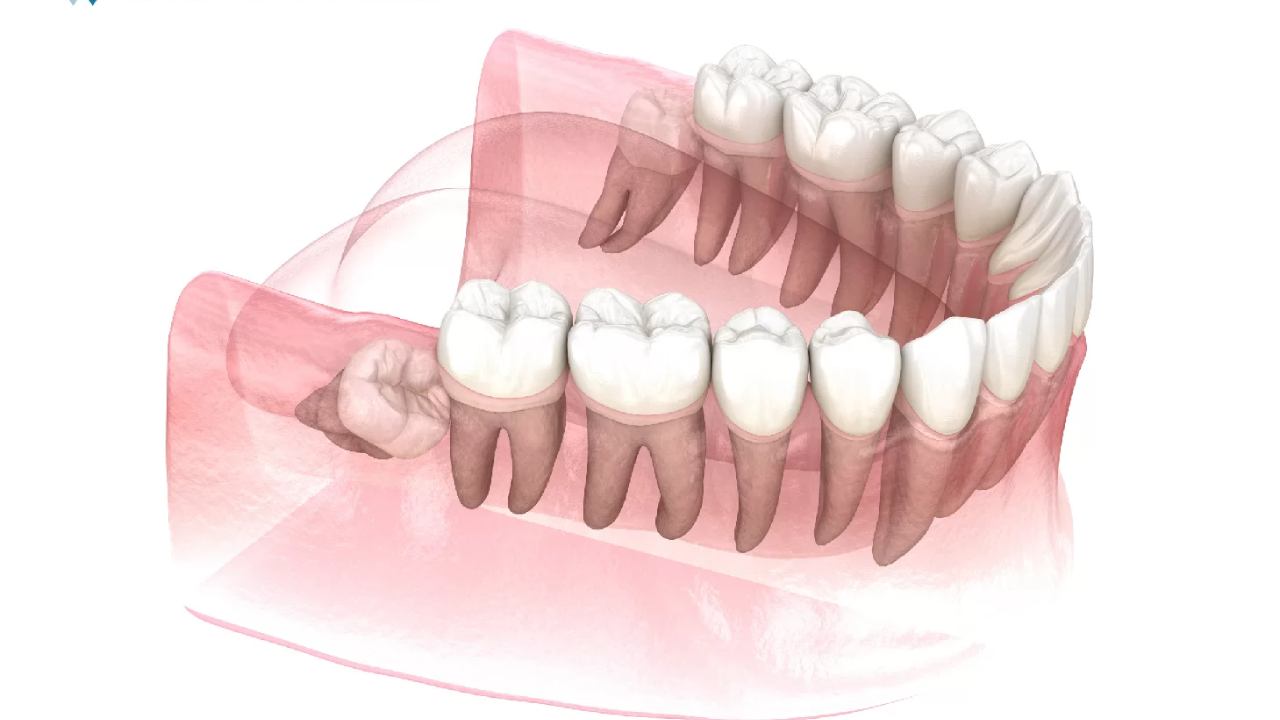 Giải đáp: răng khôn mọc lệch có nên nhổ không