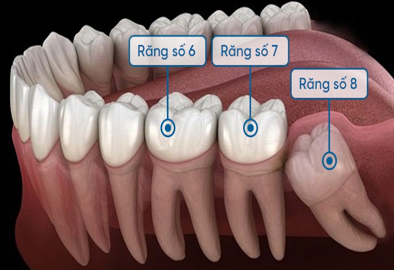 Giải đáp: răng khôn mọc lệch có nên nhổ không