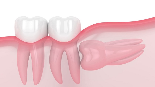 GIẢI ĐÁP: Răng số 8 mọc lệch có nên nhổ không?