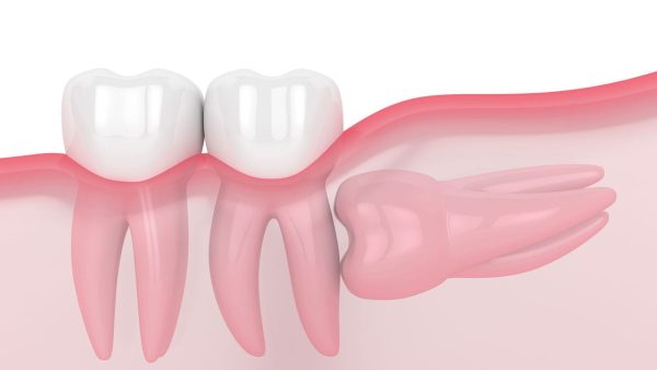 Giải đáp: Răng số 8 mọc ngầm phải làm sao?