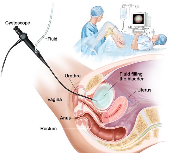 Giải đáp: sỏi bàng quang 5mm có nguy hiểm không?