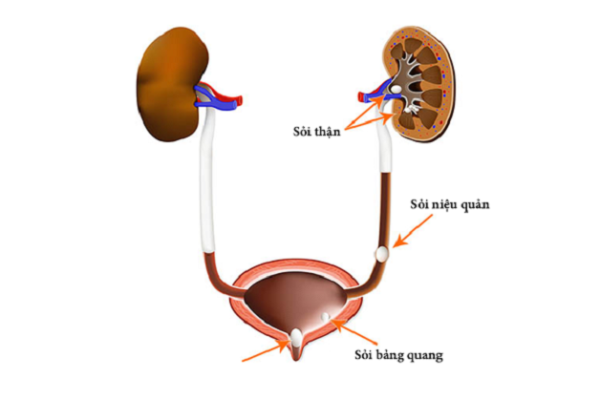 Giải đáp: Sỏi niệu quản 8mm có nguy hiểm không?