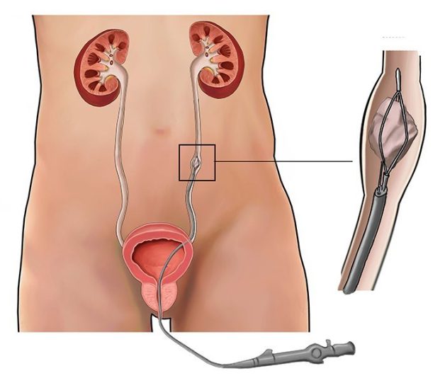 Giải đáp: Sỏi niệu quản có phải mổ không?