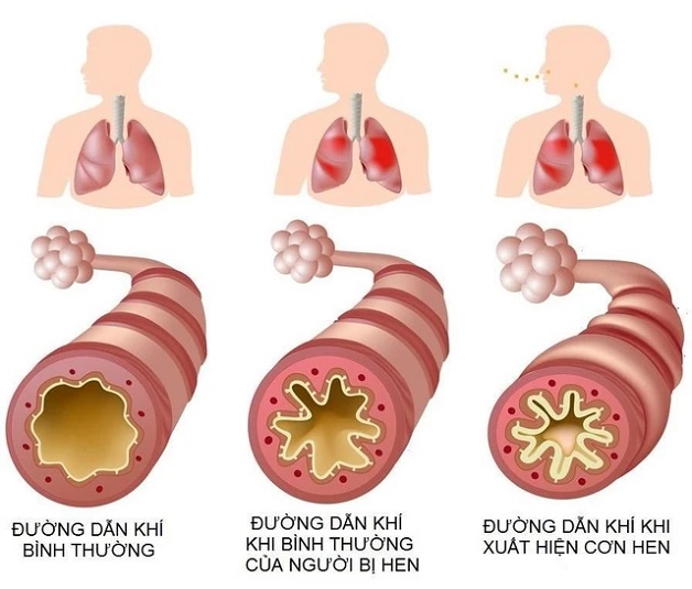 Giải đáp tại sao hen phế quản lại khó thở