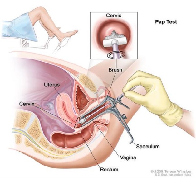 Giải đáp: Tầm soát ung thư cổ tử cung cần làm gì?