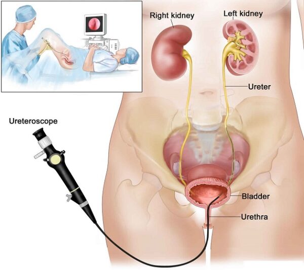 Giải đáp tán sỏi ngược dòng bằng laser có an toàn không?