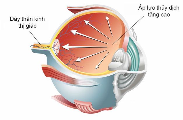 [Giải đáp] Tăng nhãn áp có chữa được không?