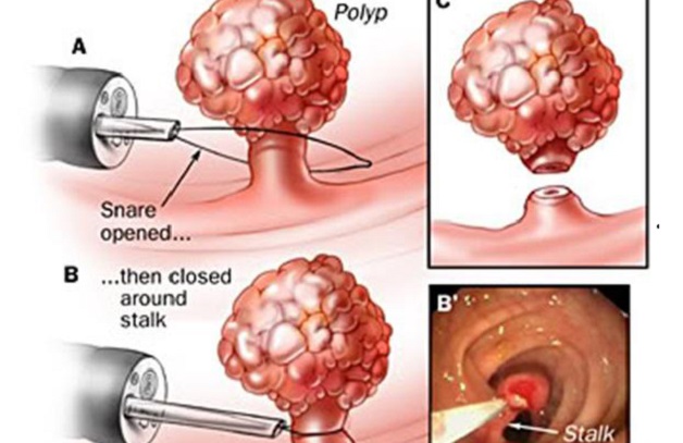 phau thuat polyp dai trang 3