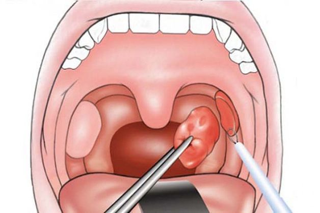 Giải đáp thắc mắc: Cắt amidan bao lâu thì nói được?