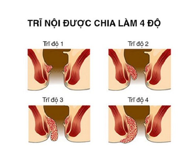 [Giải đáp thắc mắc] Cắt trĩ bao lâu thì lành vết mổ và hết đau?