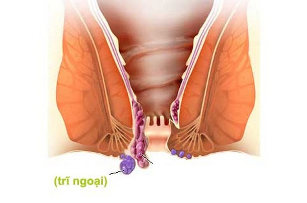 [Giải đáp thắc mắc] Cắt trĩ ngoại hết bao nhiêu tiền?