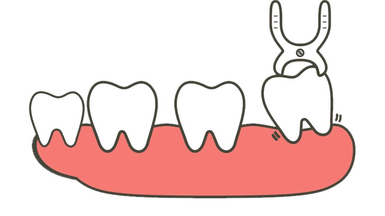 Giải đáp thắc mắc: Nên nhổ răng khôn không