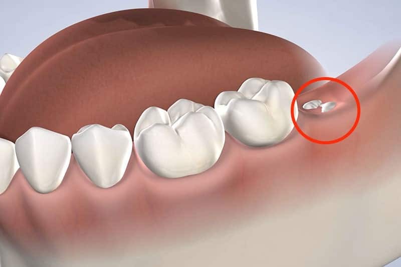 Giải đáp thắc mắc: Nên nhổ răng khôn không