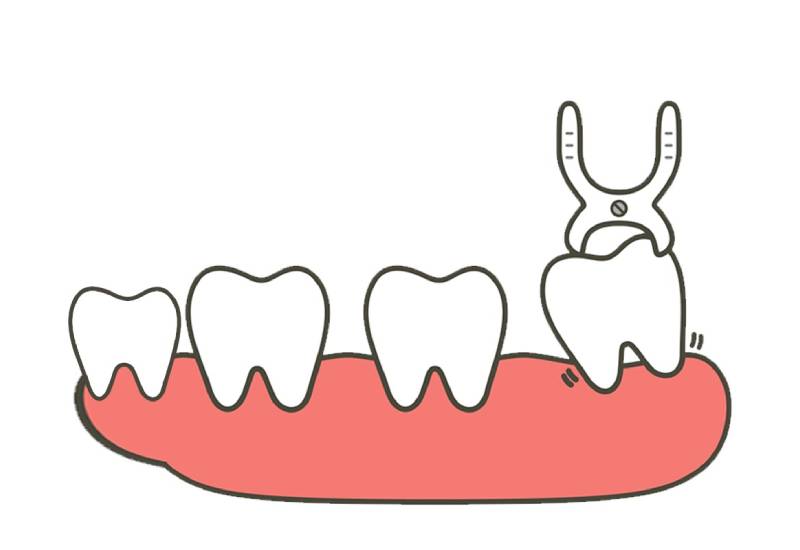 Giải đáp thắc mắc: Nên nhổ răng khôn không