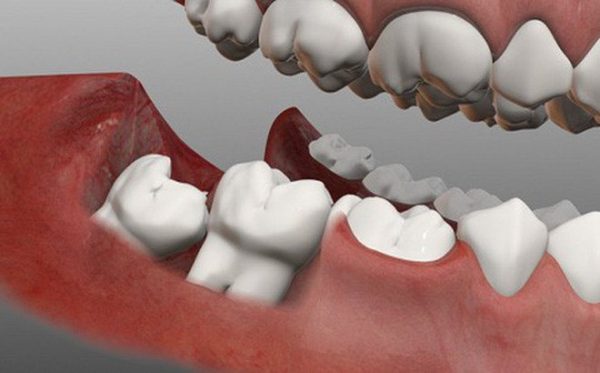 Giải đáp thắc mắc: Nhổ răng khôn hàm dưới có nguy hiểm không?