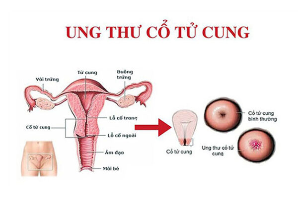 Giải đáp thắc mắc: Tầm soát ung thư cổ tử cung ở đâu tốt?