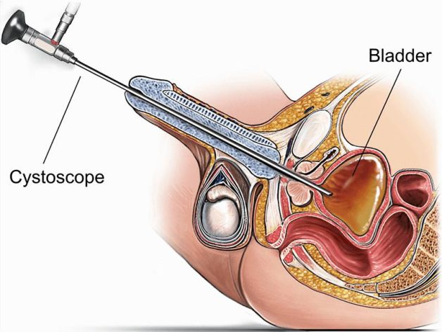 Giải đáp thắc mắc về tình trạng sỏi xuống bàng quang